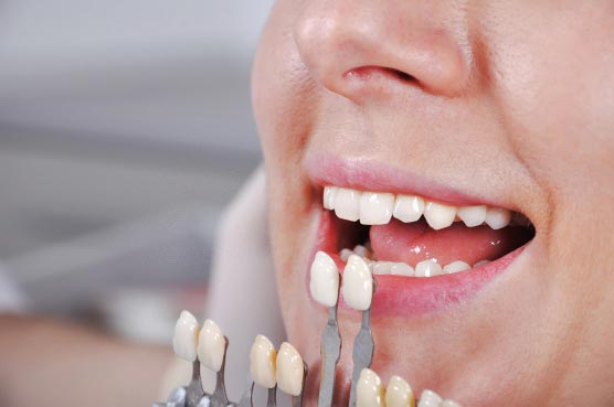 Процедура определения оттенка зуба перед отбеливанием
