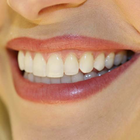 Причини, чому темніють зуби. Чому зуби чорніють під пломбами