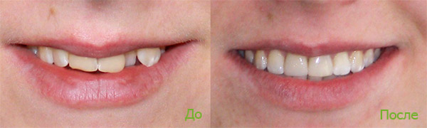 Фото до и после лечения брекетами