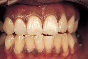 Пропорции зубов