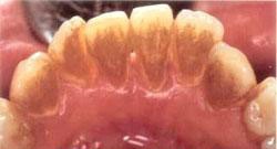 Твердий зубний наліт