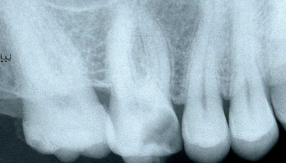 Пульпит зуба на рентгеновском снимке