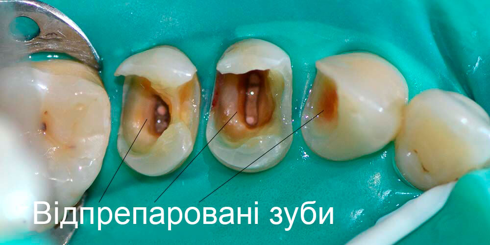 Відпрепаровані зуби