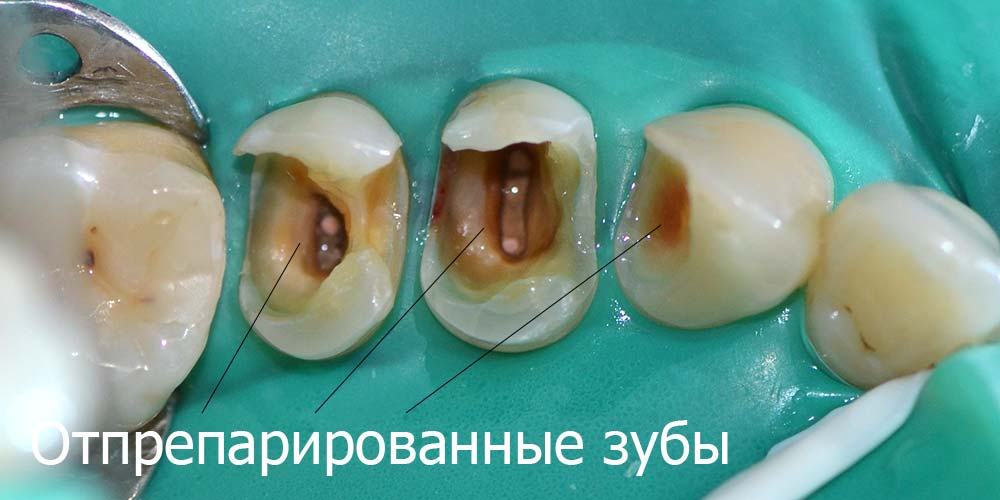 Отпрепарированные зубы