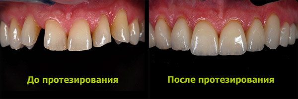 Протезирование зубов, фото до и после