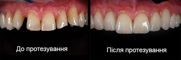 Протезування зубів. Фото до і після.