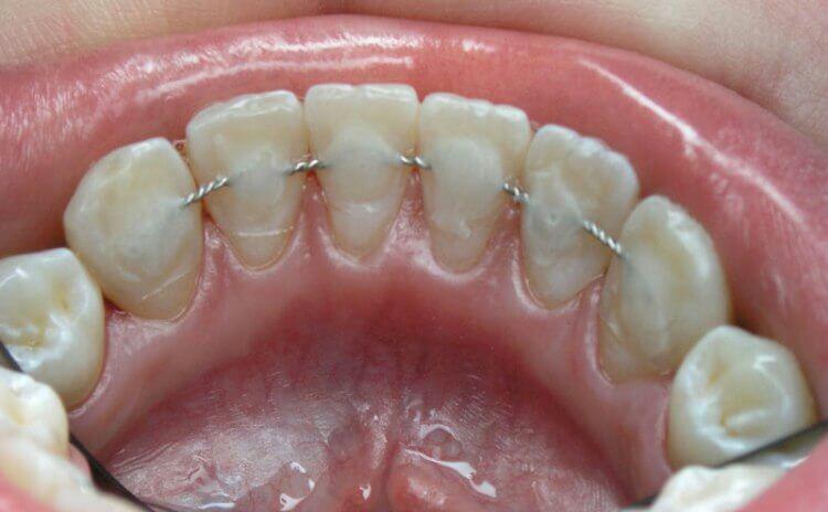 Зашинированные зубы