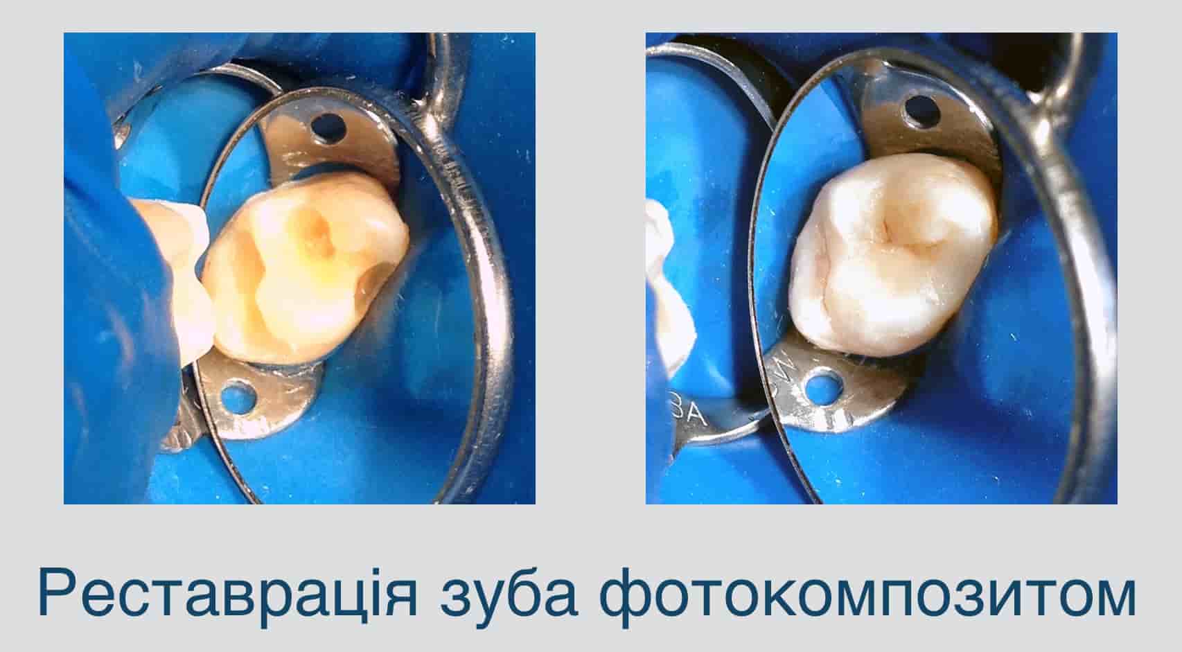Фото до і після лікування зубів, нарощування зуба, реставрація зуба - 2 ...