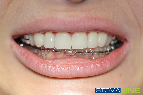 Фото1 зубів після лікування