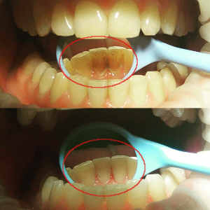 До и после профессиональной чистки зубов