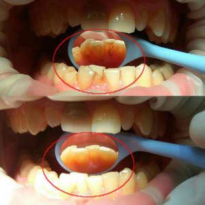 До и после профессиональной чистки зубов