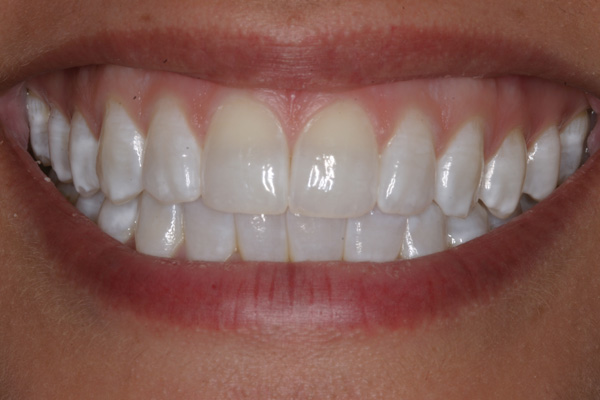 Фото14 зубів після лікування