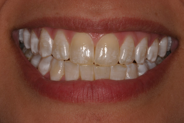 Фото14 зубів до лікування