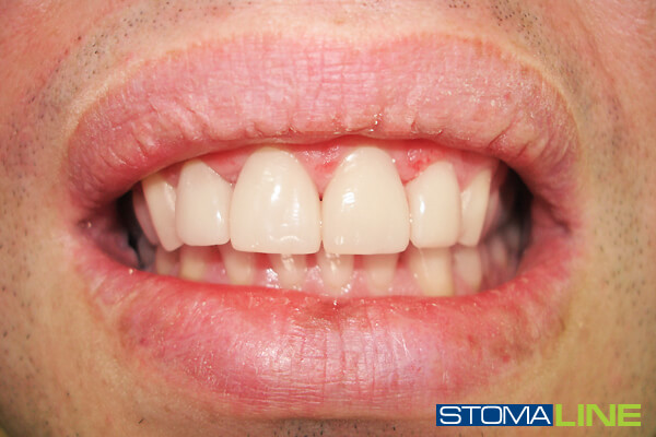 Фото10 зубів після лікування