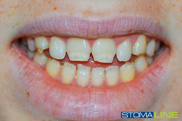 Фото3 зубов до лечения