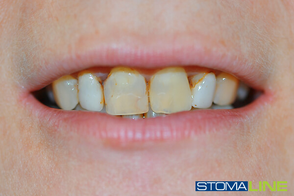Фото6 зубів до лікування