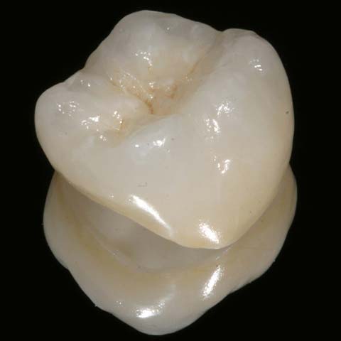 Керамическая вкладка зуба