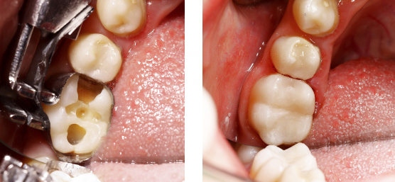 Сколько раз можно пломбировать один зуб? Признаки того, что протезирования уже не избежать