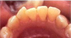 Зубы после чистки Air flow