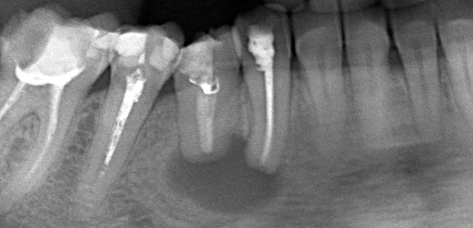 Радикулярна кіста зуба