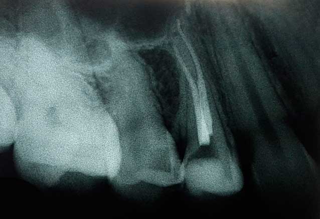 Ендодонтичне лікування зуба, рентген-знімок після лікування