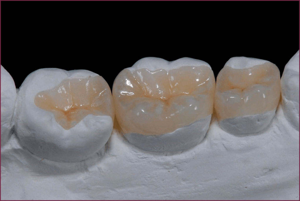 Вкладки зубов на гипсовой модели (onlay, overlay)