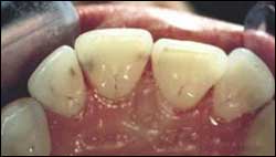 Зубы после чистки ультразвуком и Air flow
