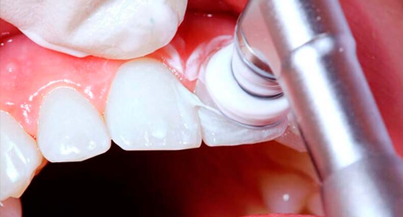 Полірування зубів спеціальною щіткою та пастою