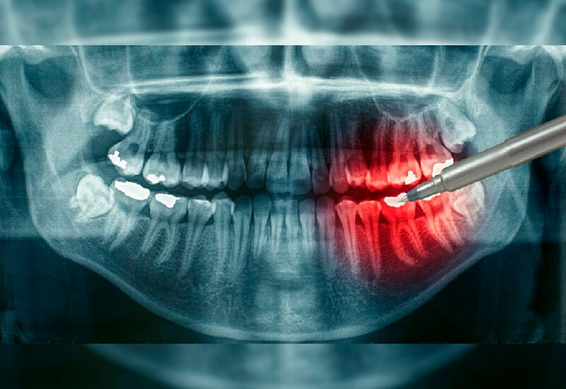Рентген больного зуба, подлежащего удалению