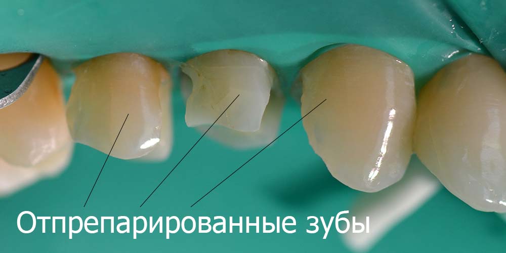 Отпрепарированные зубы