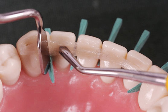 Шинування нижніх зубів скловолоконною стрічкою