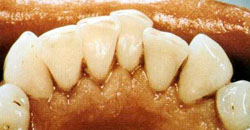Зуби після чистки Air flow