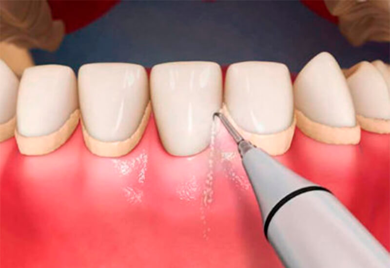 Ультразвукова чистка зубів