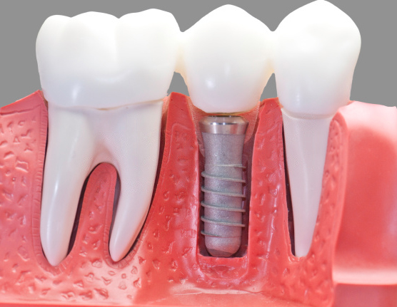Имплантация зубов цены, имплантация зубов отзывы, имплантация зуба это,  этапы имплантации зуба