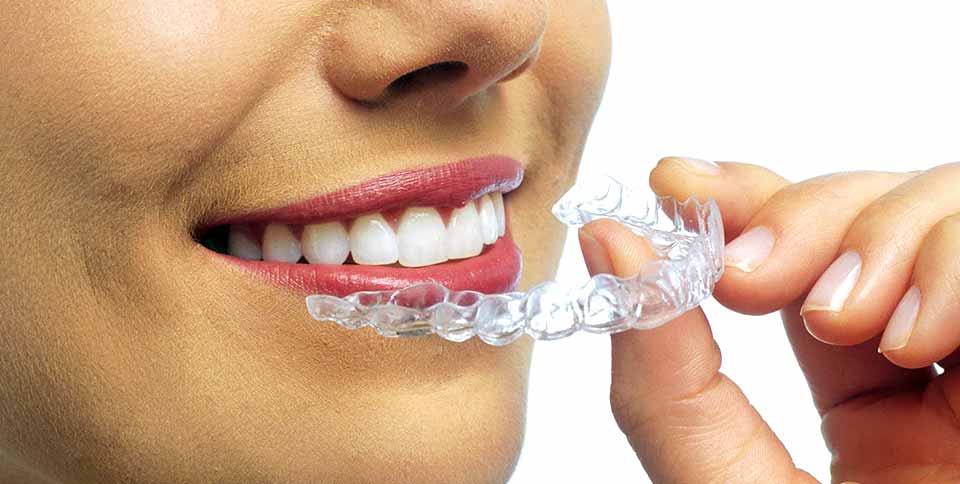 Выравнивание зубов без брекетов — Кривые зубы у мужчины старше 40 лет