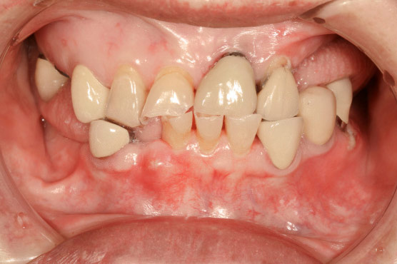 Опасен ли пародонтоз первая стоматология томск